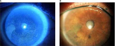 Ocular Side Effects of EGFR-Inhibitor ABT-414 in Recurrent Glioblastoma: A Long-Term Safety Study